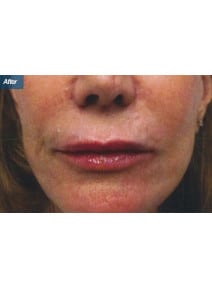 Restylane after photo, close-up view (case 9246)