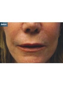 Restylane before photo, close-up view (case 9246)