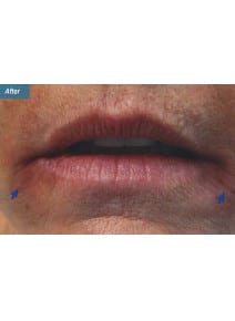 Restylane after photo, close-up view (case 9250)
