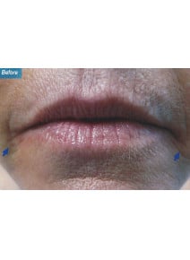 Restylane before photo, close-up view (case 9250)
