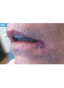 Restylane after photo, oblique left view (case 9250)