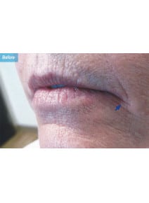 Restylane before photo, oblique left view (case 9250)