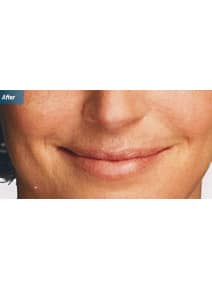 Nasolabial Folds after photo, front view (case 9257)