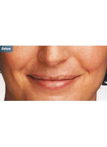 Nasolabial Folds before photo, front view (case 9257)