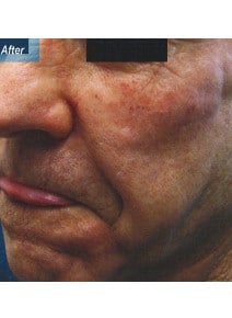 Nasolabial Folds after photo, oblique left view (case 9258)