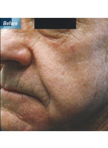 Nasolabial Folds before photo, oblique left view (case 9258)