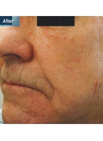 Nasolabial Folds after photo, oblique left view (case 9258)