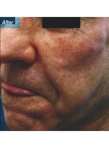 Nasolabial Folds before photo, oblique left view (case 9258)