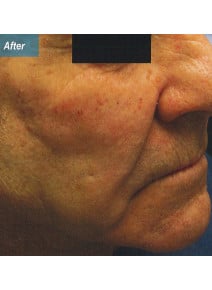 Nasolabial Folds after photo, oblique right view (case 9258)
