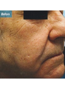 Nasolabial Folds before photo, oblique right view (case 9258)