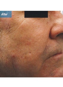 Nasolabial Folds after photo, oblique right view (case 9258)