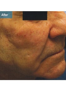 Nasolabial Folds before photo, oblique right view (case 9258)