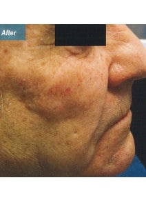 Nasolabial Folds after photo, oblique right view (case 9258)