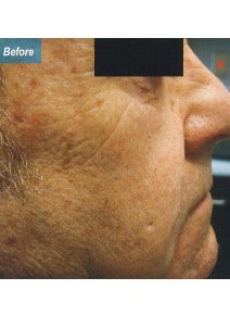 Nasolabial Folds before photo, oblique right view (case 9258)