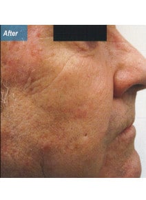 Nasolabial Folds after photo, right view (case 9258)