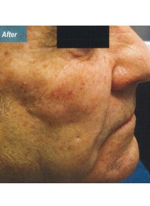 Nasolabial Folds before photo, right view (case 9258)