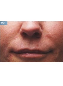 Nasolabial Folds after photo, close-up view (case 9259)