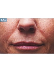 Nasolabial Folds before photo, close-up view (case 9259)