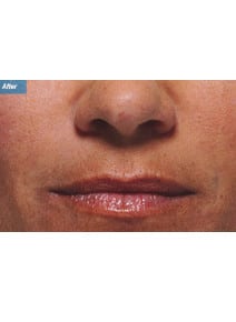 Nasolabial Folds after photo, close-up view (case 9260)