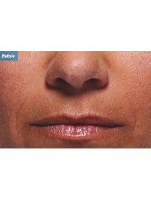 Nasolabial Folds before photo, close-up view (case 9260)