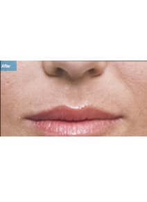 Nasolabial Folds after photo, front view (case 9261)