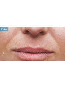 Nasolabial Folds before photo, front view (case 9261)