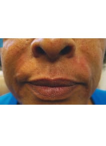 Nasolabial Folds after photo, close-up view (case 9262)