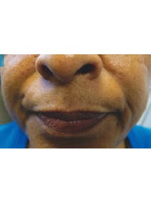 Nasolabial Folds before photo, close-up view (case 9262)