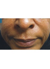 Nasolabial Folds after photo, close-up view (case 9262)