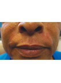 Nasolabial Folds before photo, close-up view (case 9262)