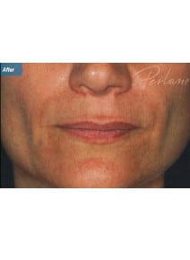 Nasolabial Folds after photo, close-up view (case 9263)