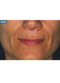Nasolabial Folds before photo, close-up view (case 9263)