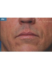 Nasolabial Folds after photo, close-up view (case 9264)