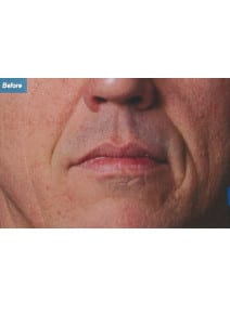 Nasolabial Folds before photo, close-up view (case 9264)