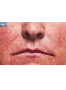 Nasolabial Folds after photo, close-up view (case 9265)