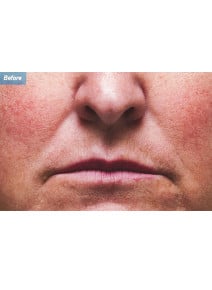 Nasolabial Folds before photo, close-up view (case 9265)
