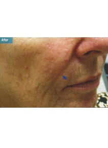Nasolabial Folds after photo, oblique right view (case 9266)