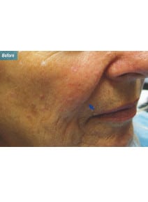 Nasolabial Folds before photo, oblique right view (case 9266)
