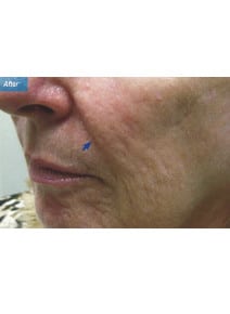 Nasolabial Folds after photo, oblique left view (case 9266)