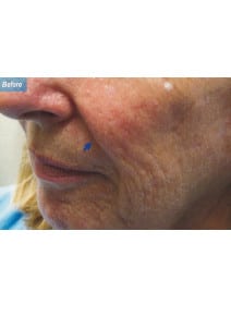 Nasolabial Folds before photo, oblique left view (case 9266)
