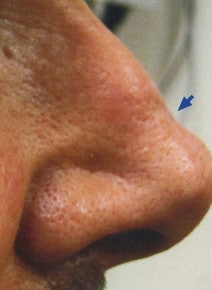 Nose Indentation Filler after photo, close-up view (case 9311)