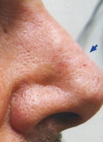 Nose Indentation Filler before photo, close-up view (case 9311)