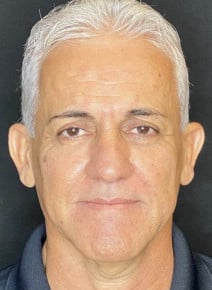 Facial Fillers and Botox after photo, front view (case 9323)