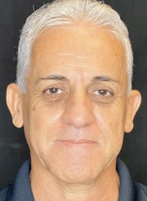 Facial Fillers and Botox before photo, front view (case 9323)