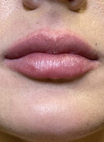 Lip Augmentation after photo, close-up view (case 9327)