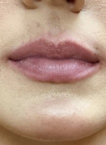 Lip Augmentation before photo, close-up view (case 9327)