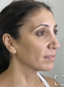 Microneedling after photo, oblique right view (case 9331)