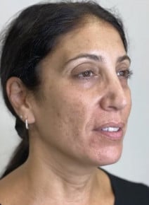Microneedling before photo, oblique right view (case 9331)
