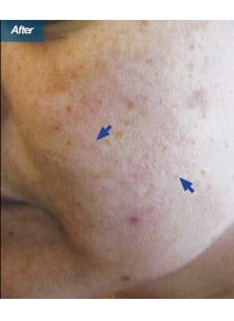 VBeam after photo, close-up view (case 9357)