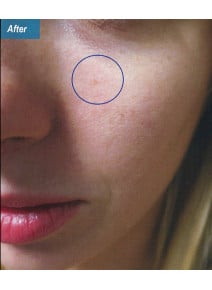 VBeam after photo, close-up view (case 9358)